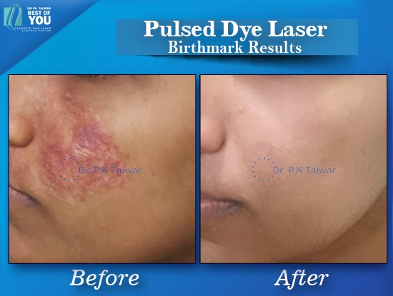Pulsed Dye Laser Result